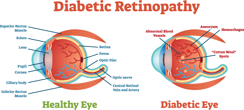 Diabetic Retinopathy Diagram
