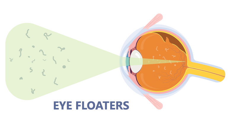 Eye Floaters Diagram