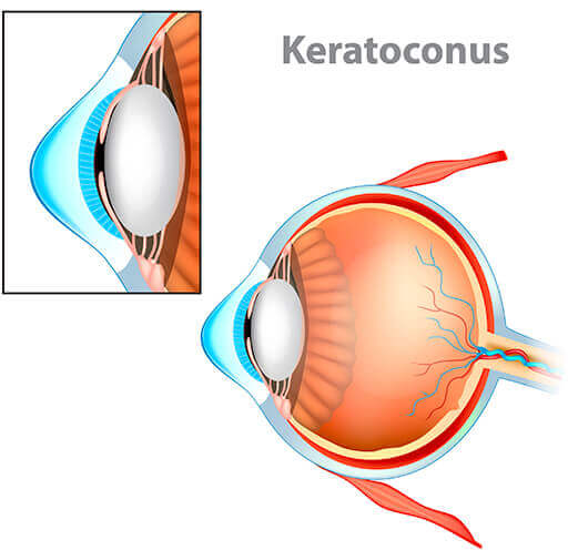 Cornea affected by Keratoconus medical illustration