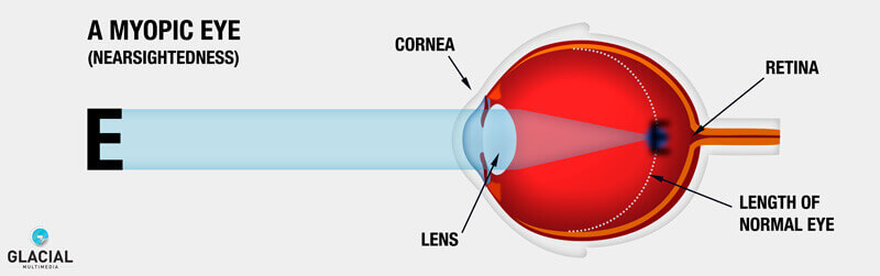 Myopic Eye diagram
