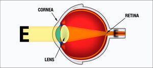 Nearsightedness retina diagram