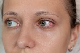 Woman with uveitis